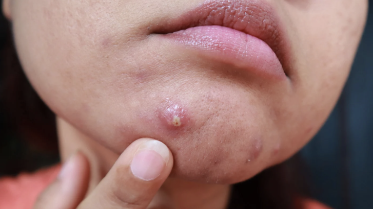 Best Dermatologist for Cystic Acne In Leonardtown Maryland